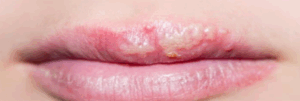 herpes
