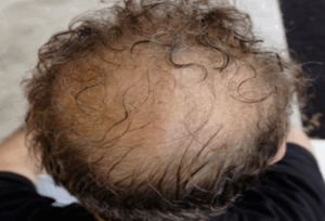 pelo